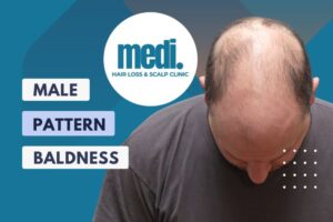 Male Pattern Baldness- Medi Hair Loss Clinic Ottawa