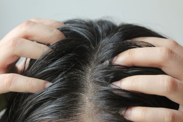 Scalp problems - Dry Scalp treatments at Medi Hair Loss and Scalp Clinic