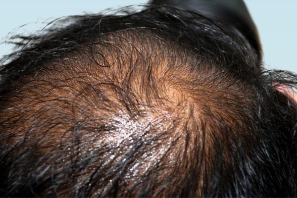 Scalp problems - Oily scalp treatments at Medi Hair Loss and Scalp Clinic