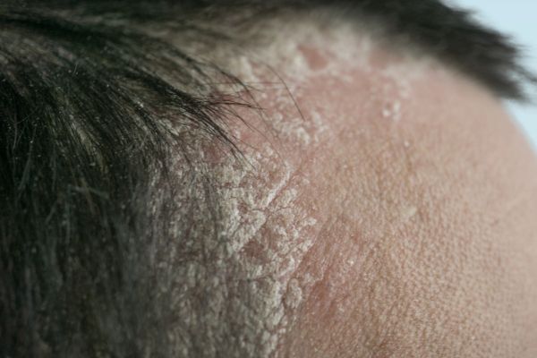 Scalp problem -Psoriasis -Treatment at Medi Hair Loss Clinic