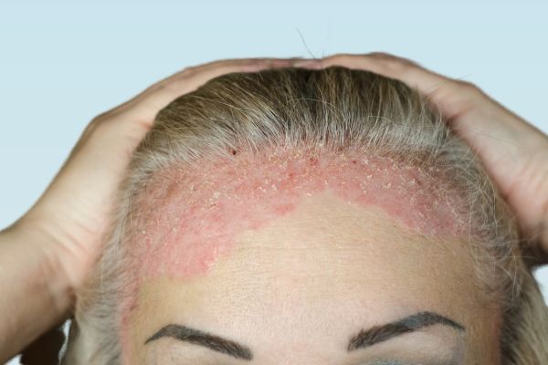 Scalp problems - Seborrheic Dermatitis treatments at Medi Hair Loss and Scalp Clinic