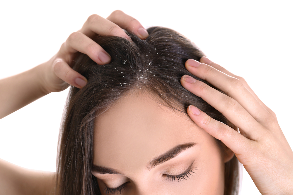 Scalp problems Dandruff or pityriasis-medi hair loss & scalp