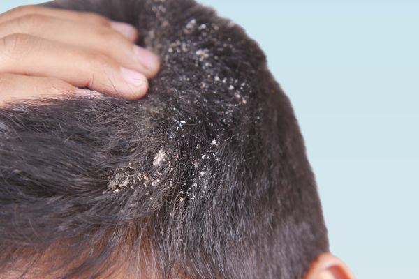 Scalp problems - Dandruff treatments at Medi Hair Loss and Scalp Clinic