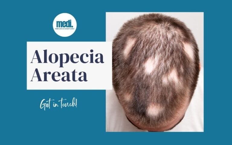 Type of Hair Loss - Alopecia Areata - Medi Hair Loss & Scalp Clinic Canada