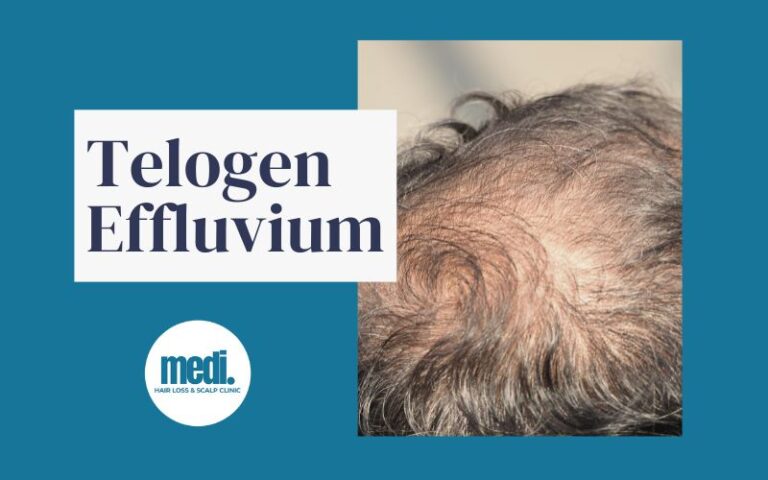 Type of Hair Loss - Telogen Effluvium - Medi Hair Loss & Scalp Clinic Canada
