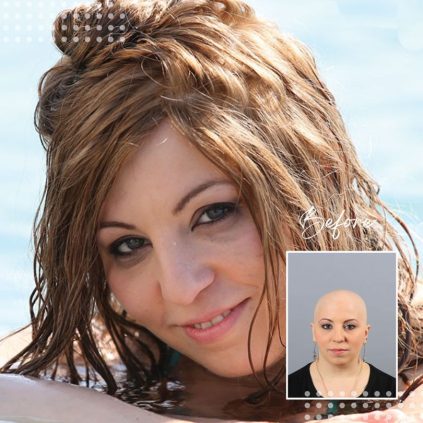 CNC hair prosthesis before and after image