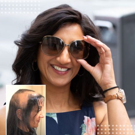 Chetna before and after CNC hair