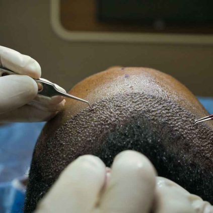 Hair Transplant Consultation Ottawa - Medi Hair Loss Clinic Ottawa