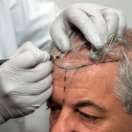 Ottawa Hair Transplant Clinic - Medi Hair Loss & Scalp Clinic
