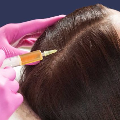 PRP for Hair Loss Ottawa