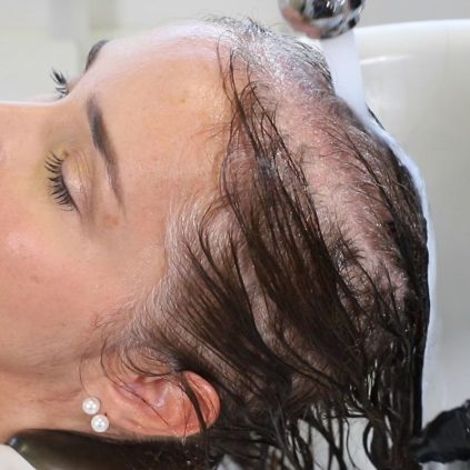 Scalp problems photo -Treatment at Medi Hair Loss Clinic